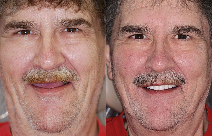 Dentier personnalisé, ajustement sécurisé, teintes naturelles – Image 12