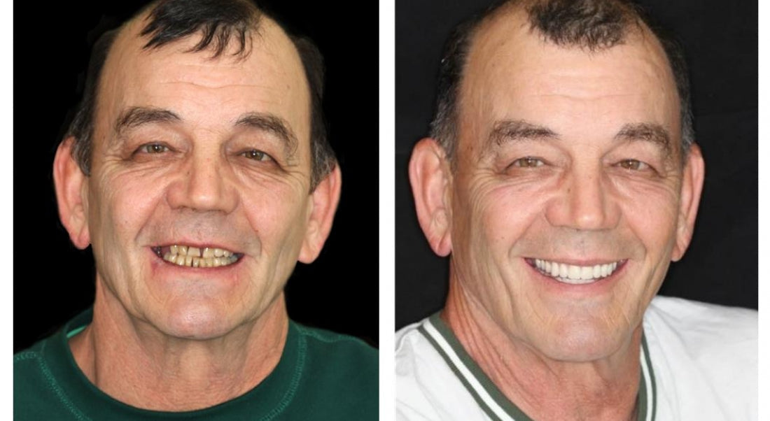 Dentier personnalisé, ajustement sécurisé, teintes naturelles – Image 13