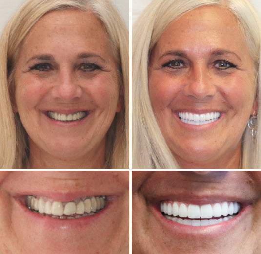 Dentier personnalisé, ajustement sécurisé, teintes naturelles – Image 5