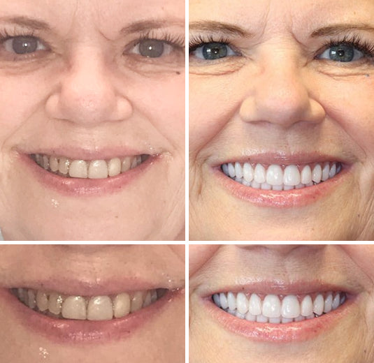 Dentier personnalisé, ajustement sécurisé, teintes naturelles – Image 6
