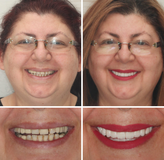 Dentier personnalisé, ajustement sécurisé, teintes naturelles – Image 7