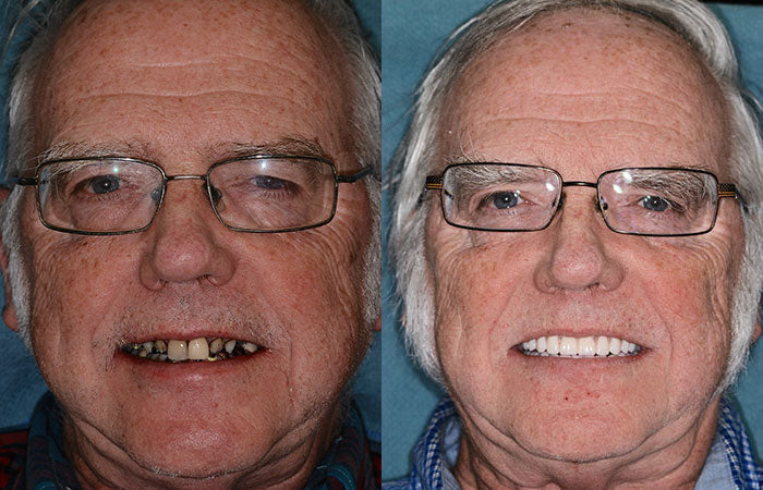 Dentier personnalisé, ajustement sécurisé, teintes naturelles – Image 8